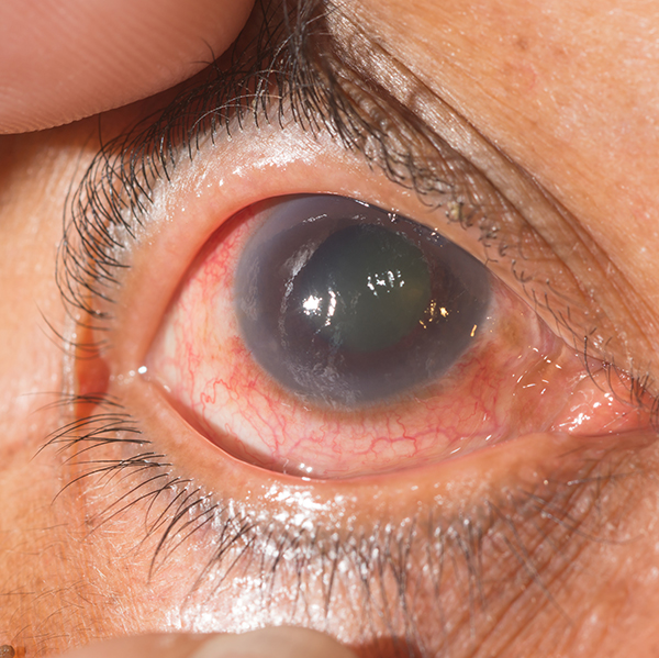 GLAUCOMA